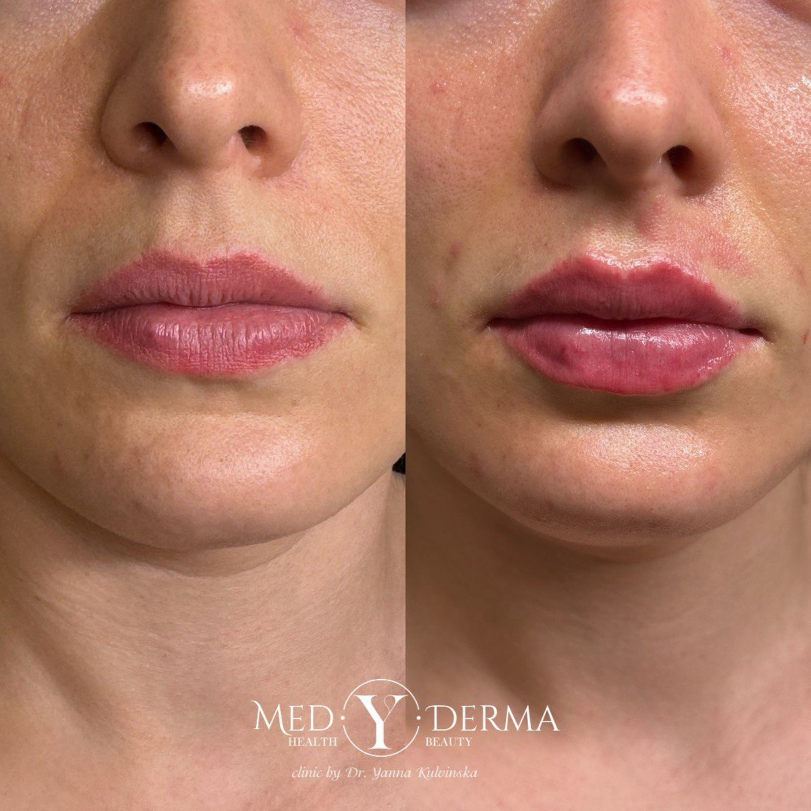 Lips Augmentation Orihuela Costa
