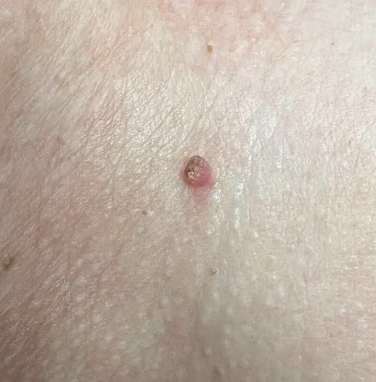 papilloma removal