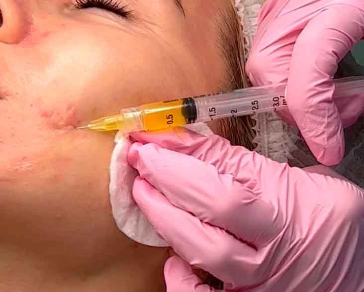 Cosmetología inyectable en Orihuela Costa