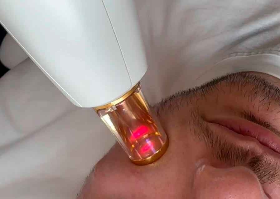 Tratamiento Laser